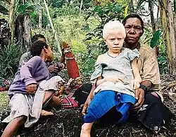 An albino girl in Papua New Guinea. Albinism can be caused by the mutation of different genes.